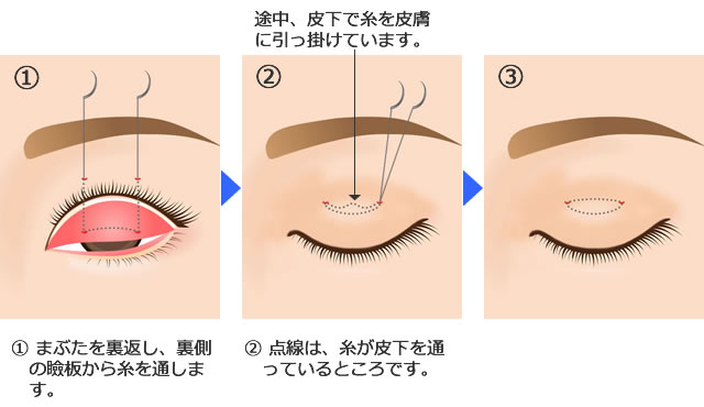 埋没法 二重手術 いしい形成クリニック 茨城県つくば市の美容外科