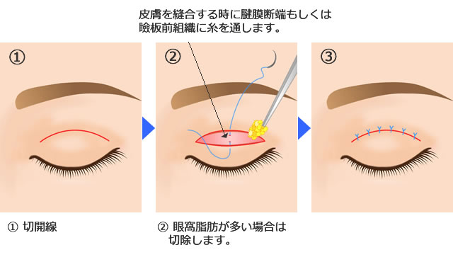 全切開法