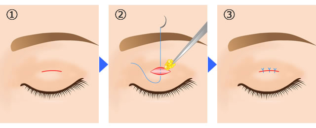 小切開法 二重まぶた手術 いしい形成クリニック 茨城県つくば市の美容外科