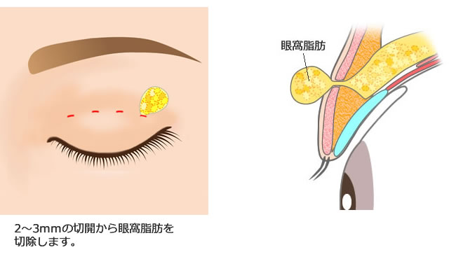 まぶた の 脂肪 取り