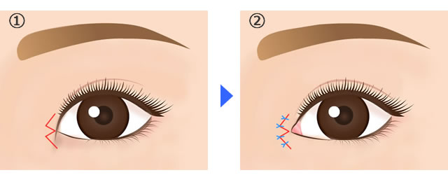 目頭切開