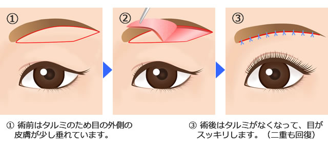 眉毛下タルミ切除