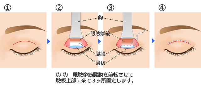 眼瞼下垂手術