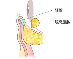 下眼瞼脱脂術