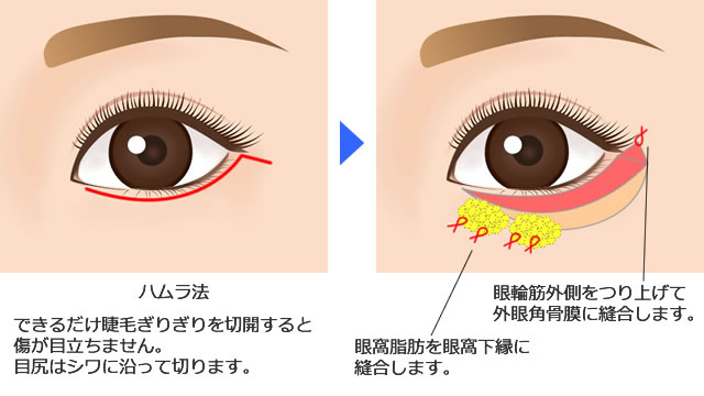 下眼瞼タルミ切除術（ハムラ法）