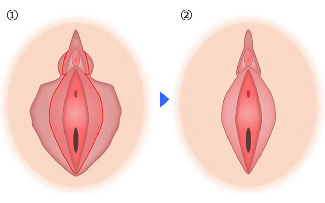 しょういんしん縮小手術