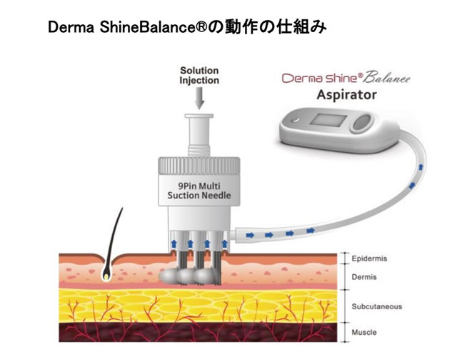 ダーマシャイン・バランスの仕組み