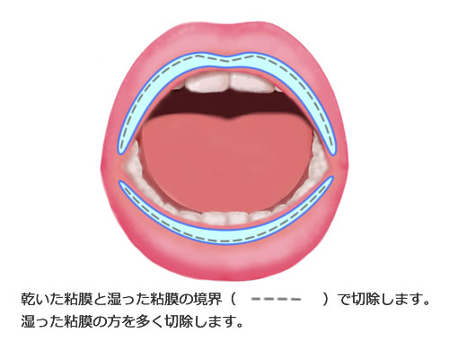 口唇縮小術（唇を薄くする手術）