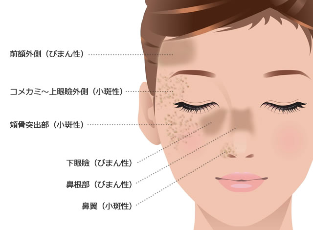 ＡＤＭ発症部位の図