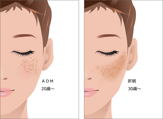 ＡＤＭと肝斑の鑑別の図